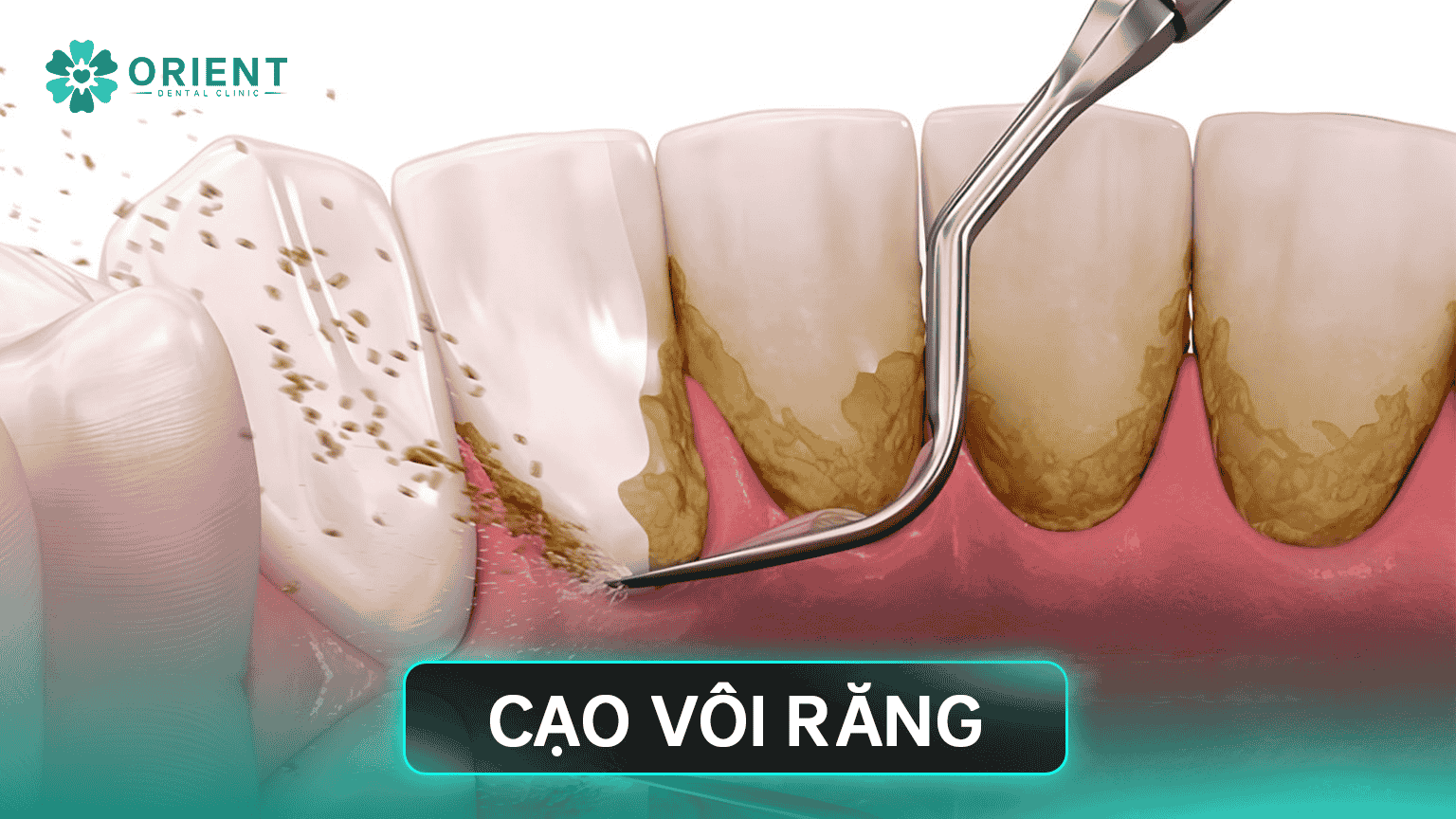 cao voi rang 1