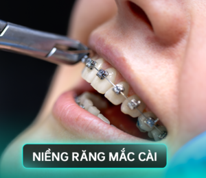 Niềng răng có đau không? Tuần đầu sẽ như thế nào
