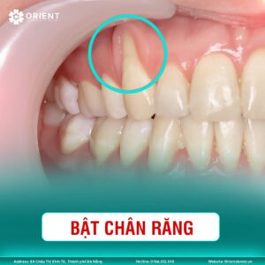 Niềng Răng Sai Cách Và Cái Giá Không Ai Muốn Trả