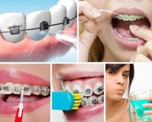 Niềng Răng Nên Ăn Gì, Kiêng Gì? 5 Cách Chăm Sóc Răng Đúng Cách 3 Niềng Răng Nên Ăn Gì, Kiêng Gì? 5 Cách Chăm Sóc Răng Đúng Cách