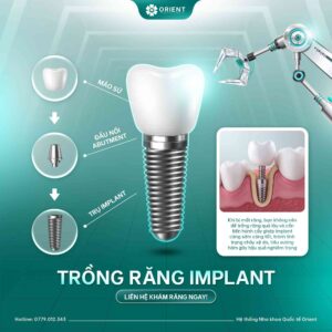 Chọn Implant Không Chỉ Nhìn Vào Giá: 5 Yếu Tố Cần Quan Tâm | Orient 7 Chọn Implant Không Chỉ Nhìn Vào Giá: 5 Yếu Tố Cần Quan Tâm