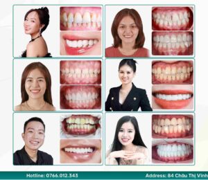 Răng Sứ Không Tự Nhiên: 3 Yếu Tố Quyết Định Thẩm Mỹ