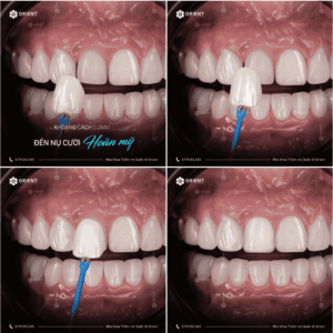 Lựa chọn phương pháp phục hình răng sứ phù hợp, ưu tiên bảo tồn răng thật