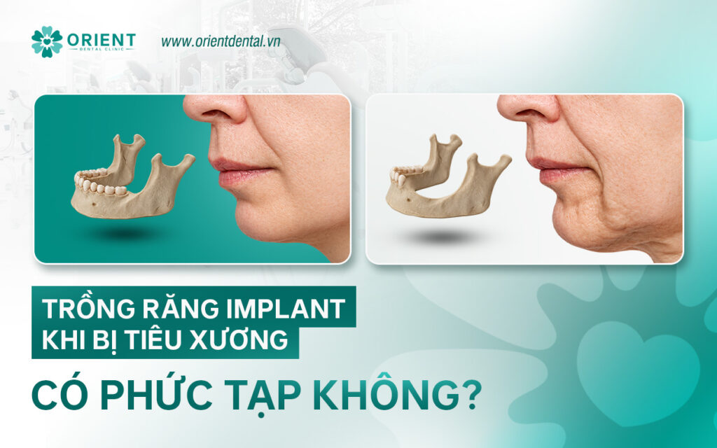 trong rang implant khi bi tieu xuong