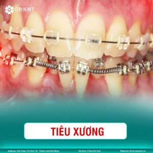 Biến chứng niềng răng sai cách gây ảnh hưởng nghiêm trọng đến sức khỏe răng miệng